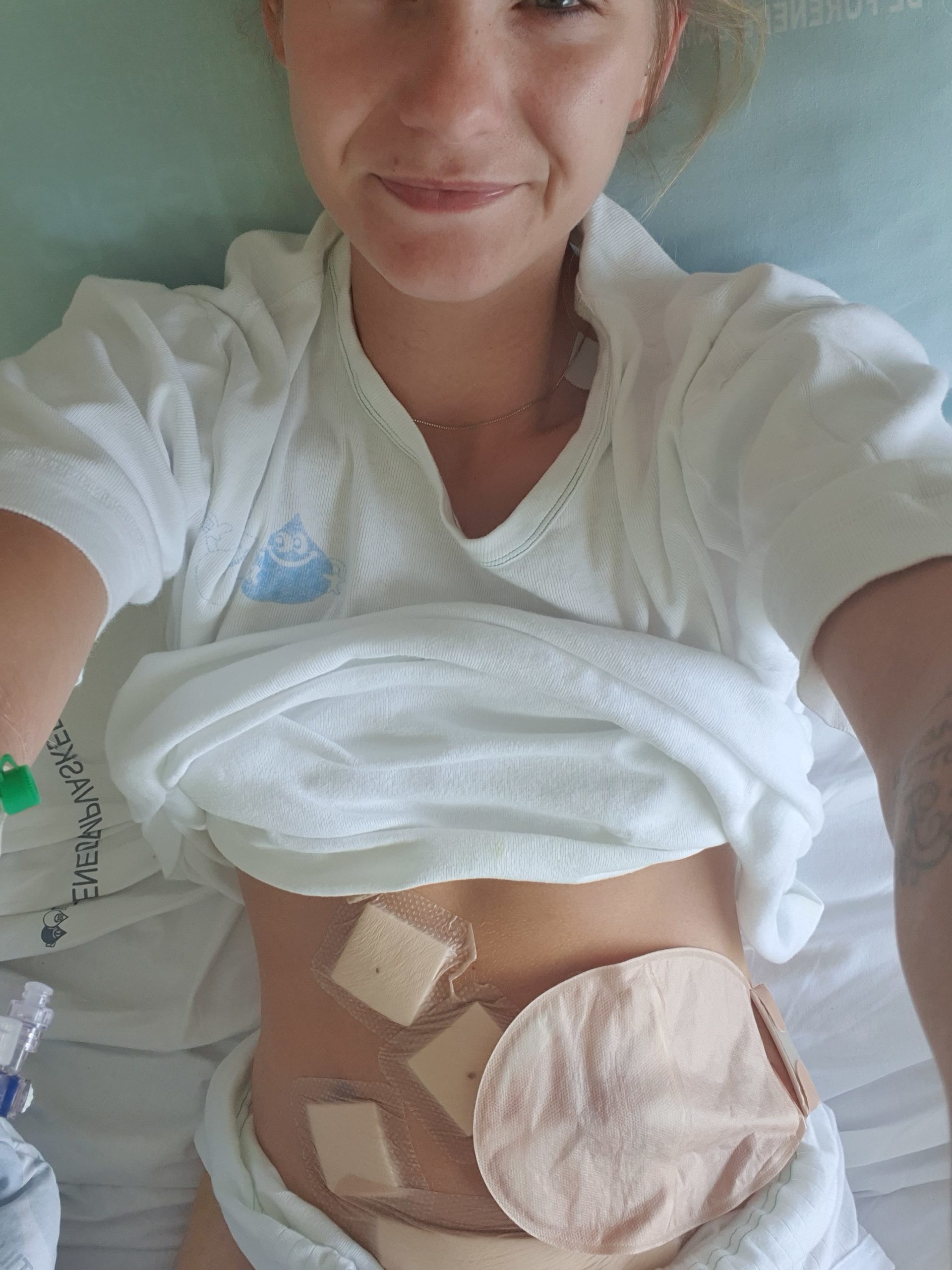 Billed af Louise med stomipose