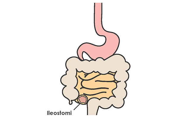 Ileostomi