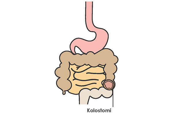 Kolostomi